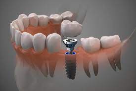 imagenes Implantes en Villa Allende